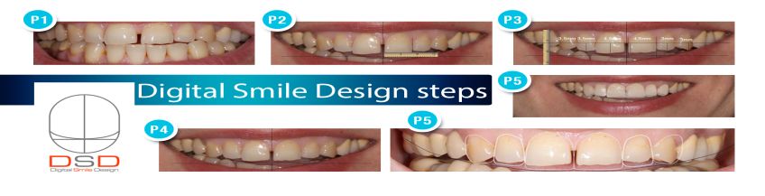 Цифровой дизайн улыбки (Эстетическая стоматология, Digital Smile Design)