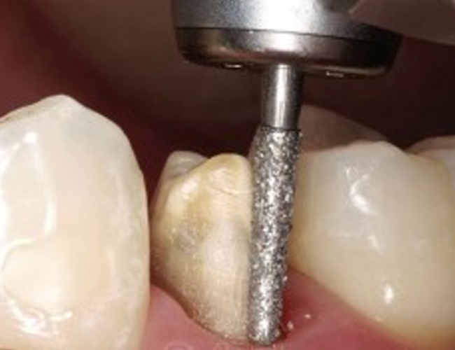 Препарирование зубов - протезировании в стоматологии