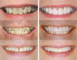 Реставрация зубов: фото до и после установки виниров