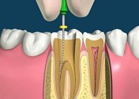 Болит зуб после удаления нерва, что делать?