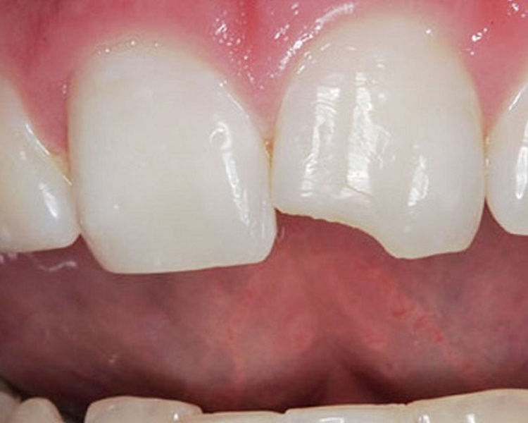 Травмы зубов