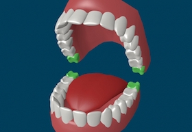 Зубы мудрости: лечить или удалять?