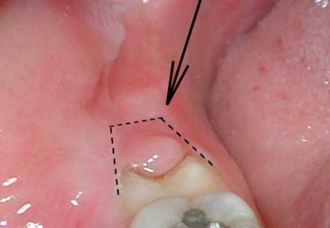 Воспаление зуба